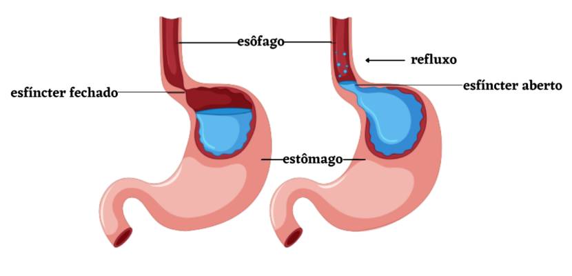 QUAL A DIFERENÇA ENTRE A PHMETRIA CONVENCIONAL E A IMPEDÂNCIO- PHMETRIA?